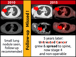 Lung nodule was seen and appropriate follow-up was recommended, but follow-up imaging was not obtained, leading to progression of cancer.  Lost Souls Radiology Recommendation Tracker helps to prevent patients being lost to follow-up.